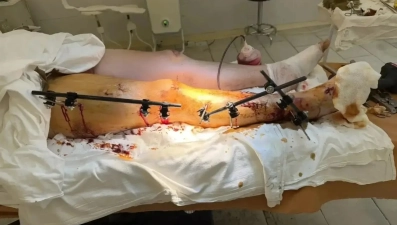 Липецкие хирурги спасли ногу 26-летнему мотоциклисту за два этапа сложнейшей операции