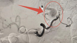 Липецкие медики спасли пациента с тяжёлой формой панкреонекроза