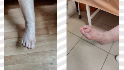 В Липецке хирурги восстановили стопу 74-летней пациентке