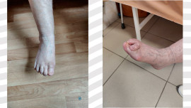 В Липецке хирурги восстановили стопу 74-летней пациентке