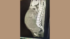 Липецкие хирурги удалили у пациентки опухоль весом 10 килограммов 