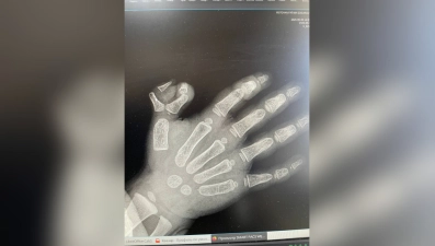 Елецкие врачи удалили шестой палец на руке двухлетней девочки