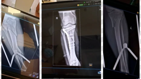 Травматологи из Липецка собрали обе голени пациента после тяжелой аварии