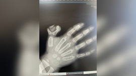 Елецкие врачи удалили шестой палец на руке двухлетней девочки