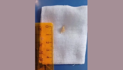 Зуб в легких полгода не давал покоя 6-летнему мальчику из Липецкой области