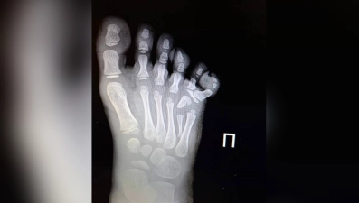 Шестой палец удалили елецкие врачи на ноге четырёхлетней девочки