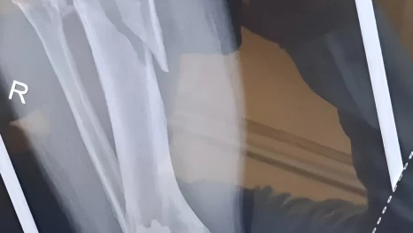 Три часа понадобилось липецким травматологам, чтобы собрать по кусочкам голень пациенту