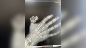 Елецкие врачи удалили шестой палец на руке двухлетней девочки