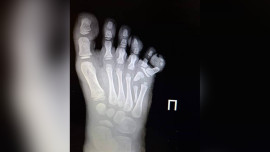 Шестой палец удалили елецкие врачи на ноге четырёхлетней девочки