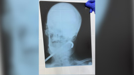 Метровый металлический прут достали из горла липецкого пенсионера