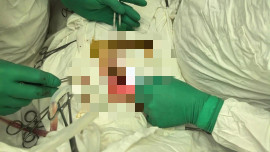 В Липецке впервые провели уникальную операцию по реконструкции трахеи