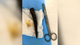 Липецкие врачи извлекли кусок арматуры из стопы подростка