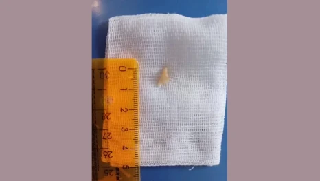 Зуб в легких полгода не давал покоя 6-летнему мальчику из Липецкой области