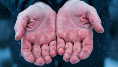 В Липецке за выходные госпитализировали четверых человек с обморожениями