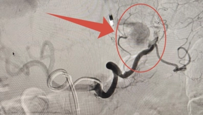 Липецкие медики спасли пациента с тяжёлой формой панкреонекроза